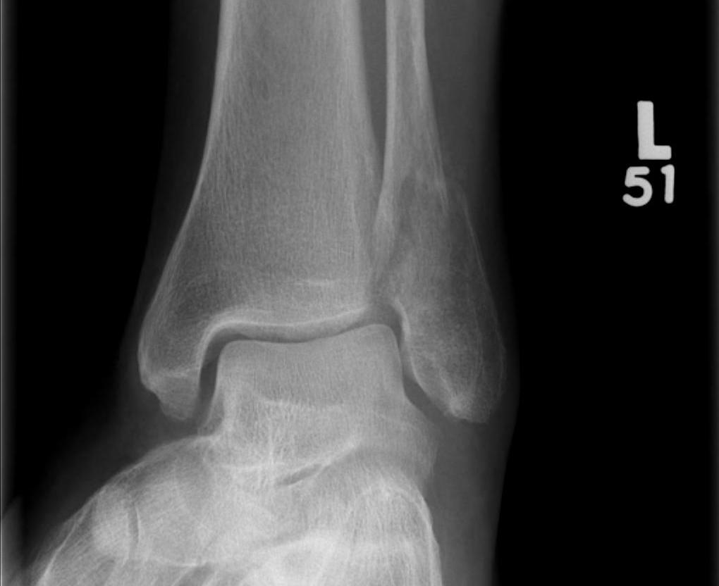 Ankle Fracture Isolated Weber B